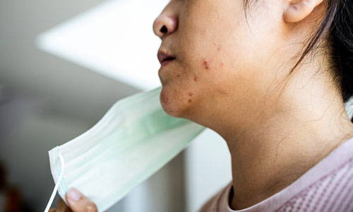 Maskne: Avoiding breakouts and acne from wearing face masks